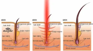 علت زیرپوستی شدن موها بعد از لیزر