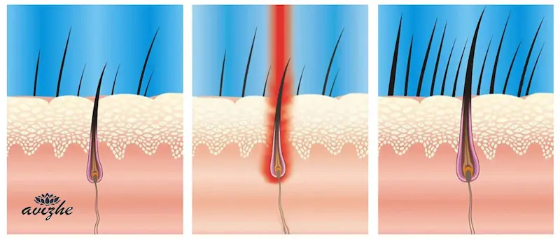 درمان موهای زیر پوستی بعد از لیزر