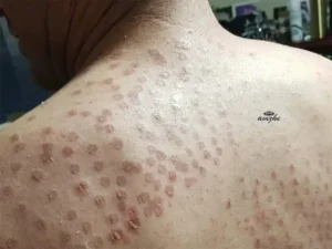 عکس سوختگی بعد از لیزر