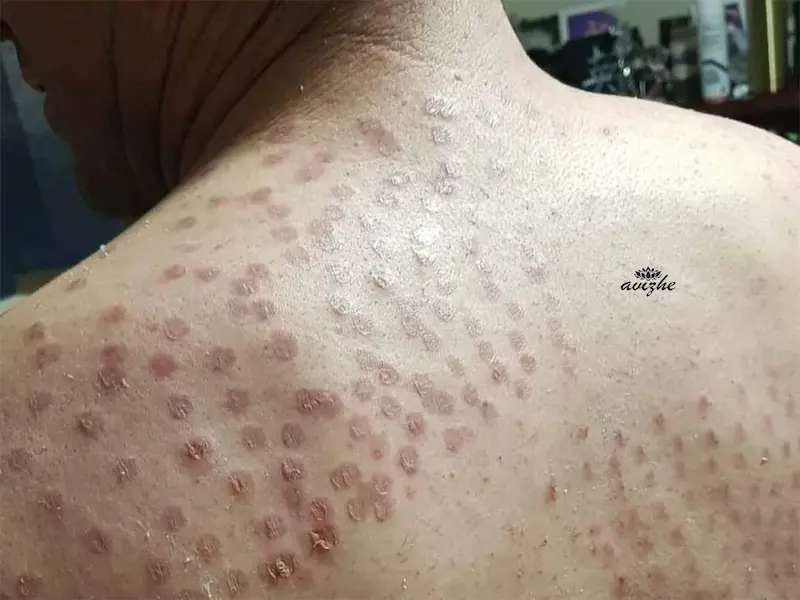 عکس سوختگی بعد از لیزر